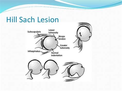 LESION DE BANKART Y HILL SACHS PDF