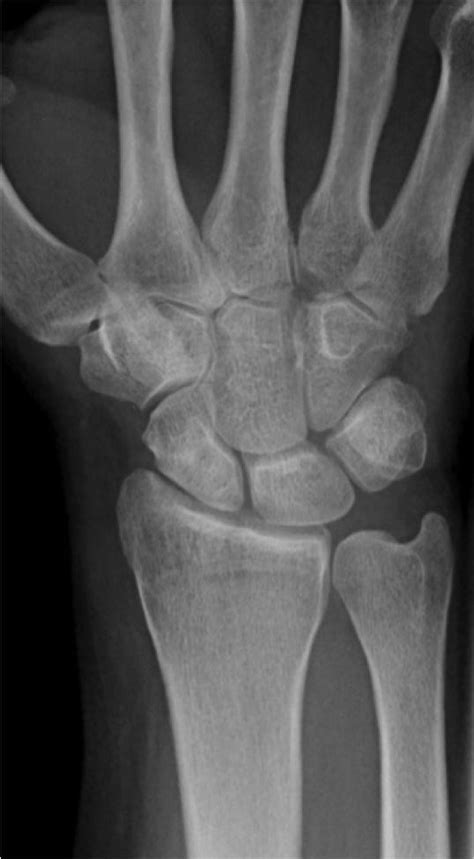 WRIST XRAY | Buyxraysonline