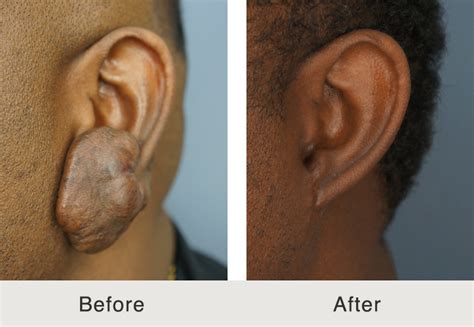 Keloid Scar Removal - Carolina Facial Plastics