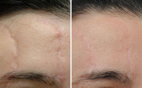 Scar Revision Treatment | Annapolis MD Facial Plastic Surgeon