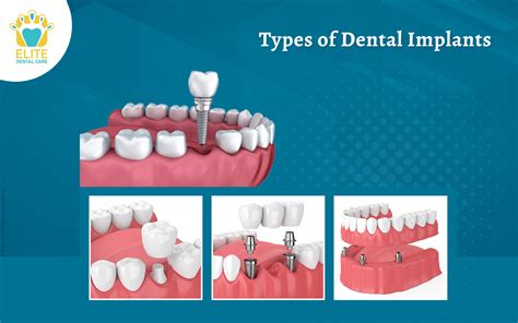 Types of Dental Implants | Elite Dental Care