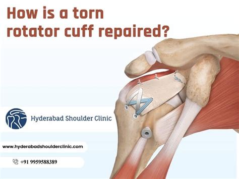 How Is A Torn Rotator Cuff Repaired?