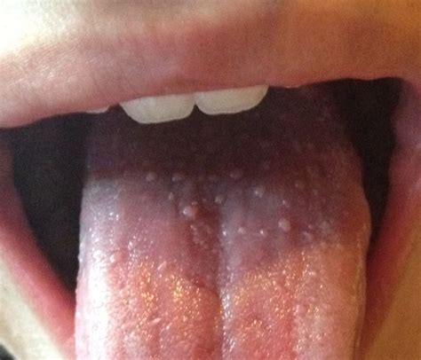 Bumps on Tongue - Symptoms, Causes, Treatment, Pictures | Diseases Pictures