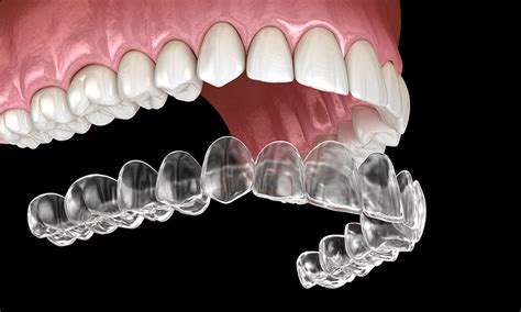 How Much Does Invisalign Cost In Houston? | Voss Dental - Oral Surgery ...