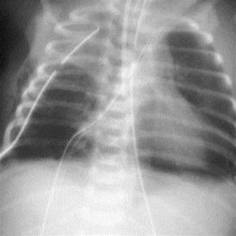 Chest radiograph 24 hours after repair of Bochdalek hernia. The grossly ...