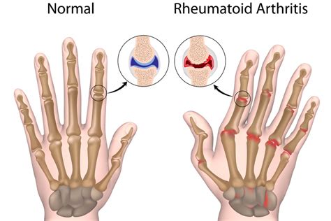 6 Types Of Arthritis: Which Is The Most Common? | Morada Senior Living