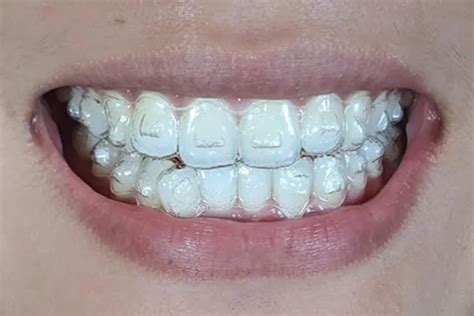 The Role of Attachments in Invisalign Treatment Explained