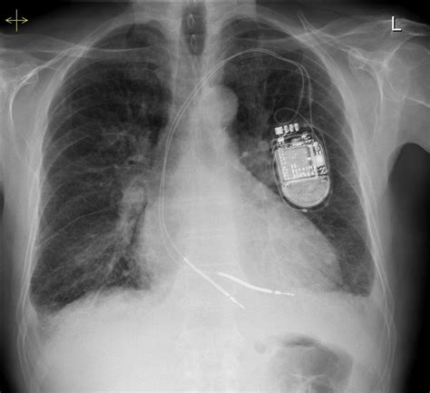 Kerley B Lines Cxr : Septal lines in lung | Radiology Reference Article ...