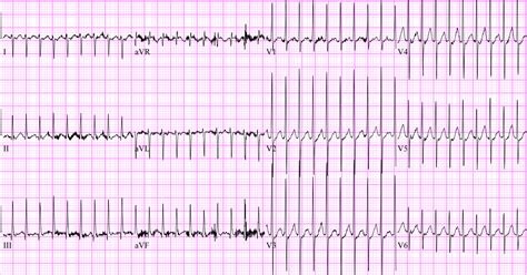 Pediatric SVT – EM Sim Cases