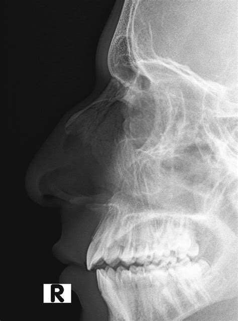 Nasal Bone X Ray Anatomy