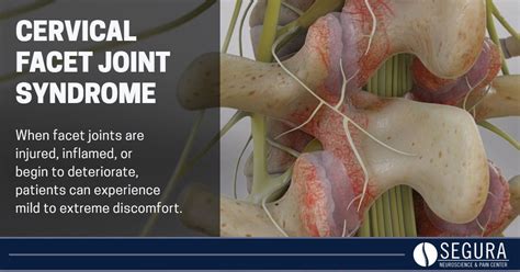 Cervical Facet Joint Syndrome - Segura Neuroscience & Pain Center