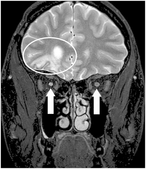 Traumatic optic neuropathy‑a contralateral finding: A case report