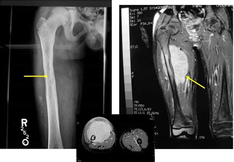 Ewing Sarcoma X Ray