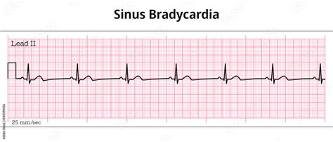 ECG Sinus Bradycardia - 8 Second ECG Paper Stock Vector | Adobe Stock