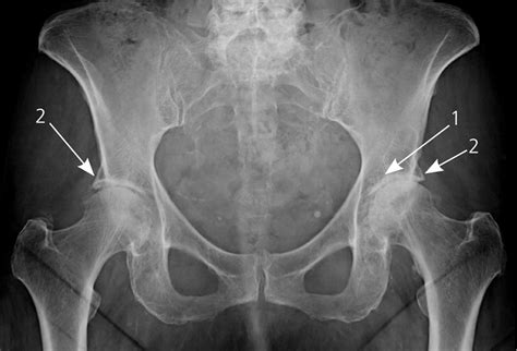 Degenerative Joint Disease - Causes & Treatment