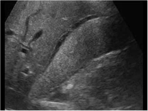 Abdomen and retroperitoneum | 1.2 Gallbladder and bile ducts : Case 1.2 ...