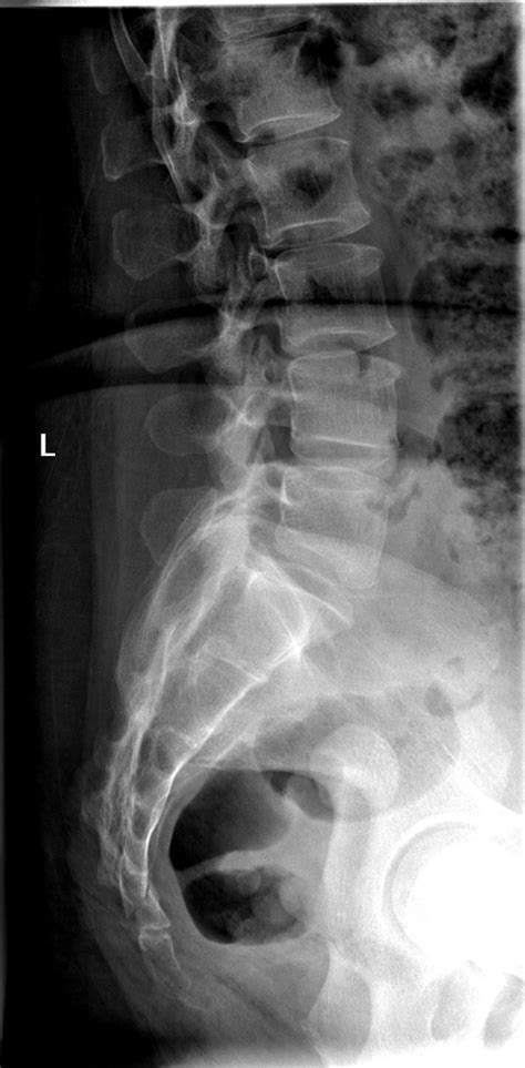 Sacrum Xray