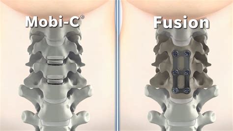 New procedure improves cervical spine surgery outcomes