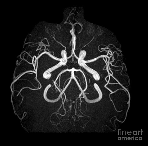 Normal Intracranial Mra Photograph by Living Art Enterprises