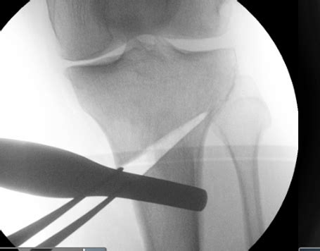 The Knee Clinic - Knee Osteotomy