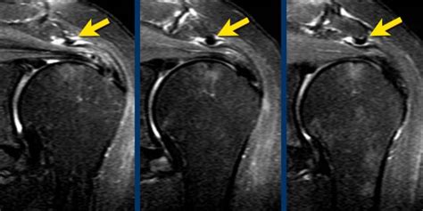 Supraspinatus Tear Mri