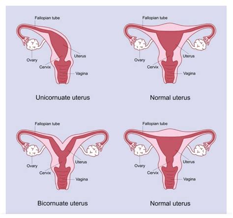 SEPTATE UTERUS (Part 2) – THISDAYLIVE