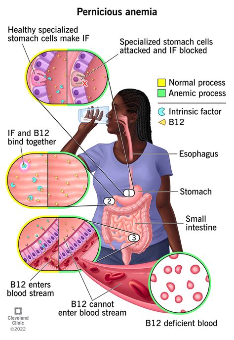 Pernicious Anemia: Definition, Symptoms, Causes & Treatment