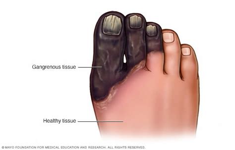 Gangrene - Symptoms and causes - Mayo Clinic