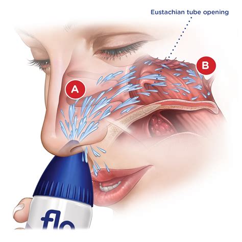 Ear Infections — Earbus Foundation