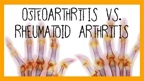 Osteoarthritis Vs Rheumatoid Arthritis | Hot Sex Picture