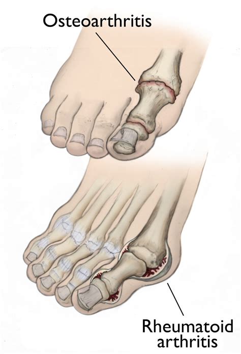 psoriatic arthritis feet Archives - DeNiel Foot and Ankle Center ...