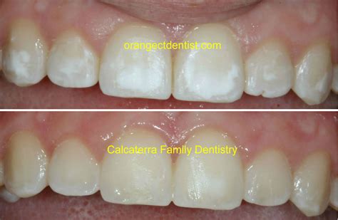 How To Reduce White Spots On Teeth - TeethWalls