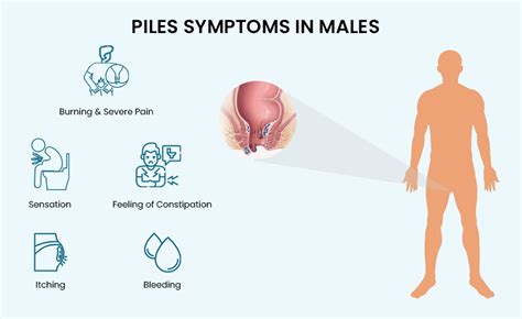 Best Way to Cure Piles in 3 Days : Symptoms, Causes, and Treatments ...