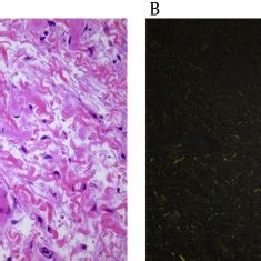 (PDF) Bullous skin lesions in a patient with end-stage renal disease ...