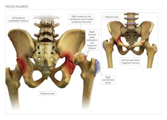 Trial Graphics - Pelvis Surgery | High Impact, LLC