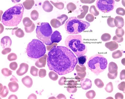 Promyelocytes And Myelocytes Related in 2023 | Hematology, Medical ...