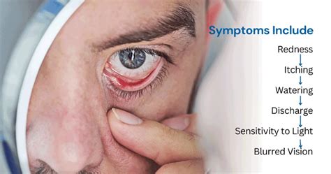 Conjunctivitis Unmasked: Understanding the Common Eye Flu