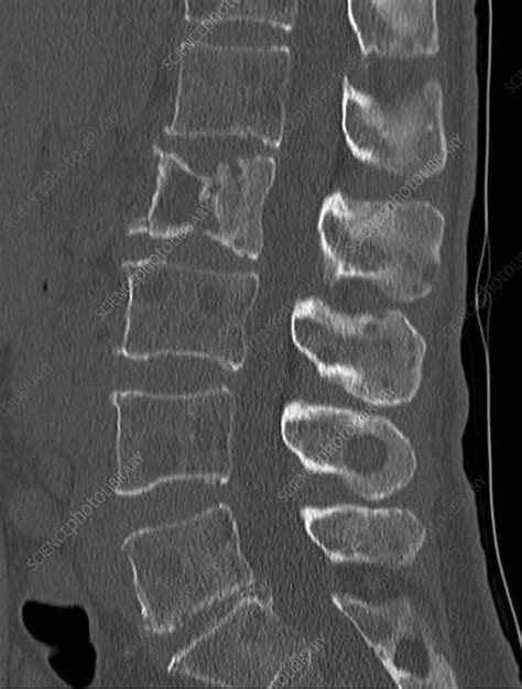 Secondary bone cancer in the spine, CT scan - Stock Image - C033/7534 ...