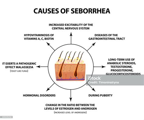 Causes Of Seborrhea Seborrhea Skin And Hair Dandruff Seborrheic ...