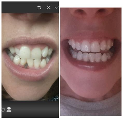 Invisalign Update: 2 Years Of Wearing Braces | Irish Travel Bloggers ...