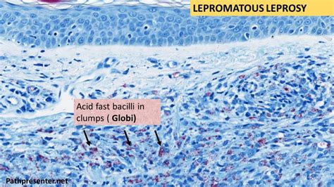 LEPROSY- Tuberculoid & Lepromatous | Pathology Made Simple