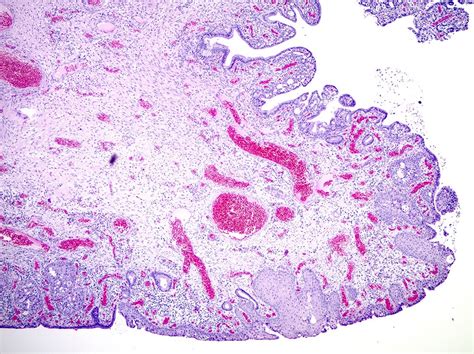 Pathology Outlines - Endocervical polyp