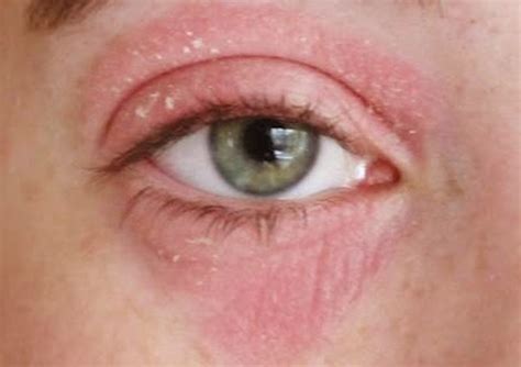 Allergic Reaction To Makeup Under Eyes - Mugeek Vidalondon