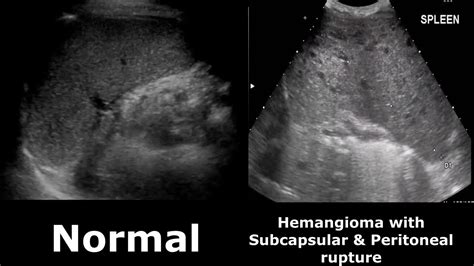 Normal And Enlarged Spleen