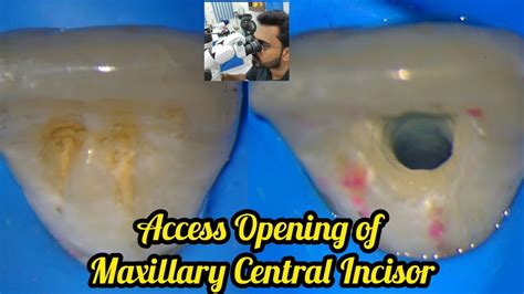 Access opening of Maxillary Central Incisor step by step demonstration ...