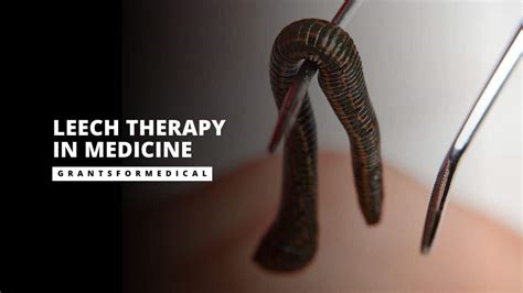 Leech Therapy in Medicine – Separating Myths from Facts