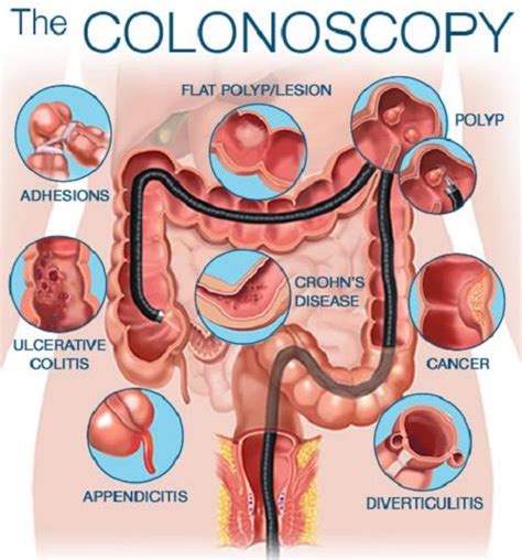 Image result for sigmoidoscopy | GI TRACT | Gastroenterology, Nclex rn ...