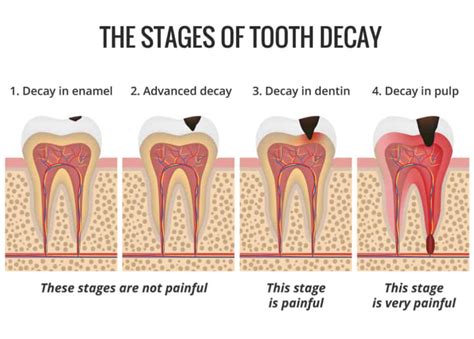 What does a cavity look like? Identifying tooth decay