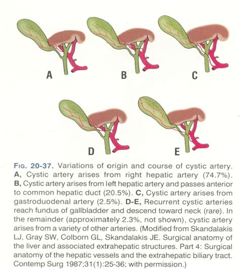 Figure 3 from A prospective study of the laparoscopic anatomy of calots ...