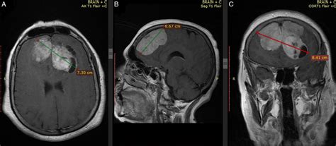 Massive cystic falcine meningioma presented with slight symp ...